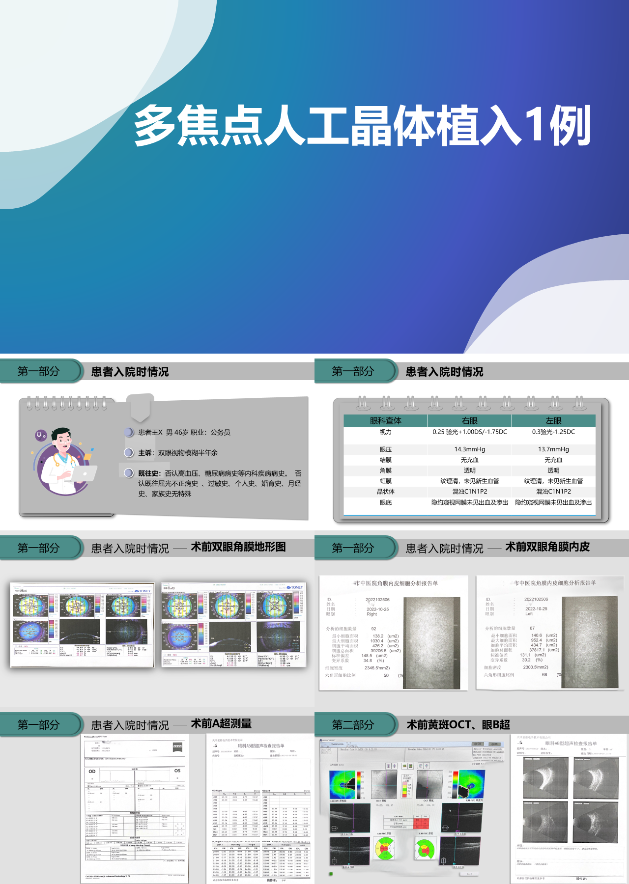 简单动态蓝色医学讲解多焦点人工晶体置入1例