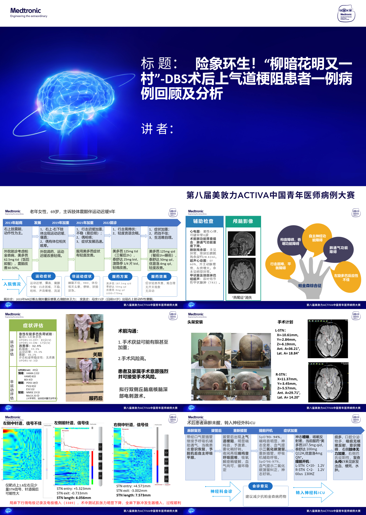 简单静态蓝色医学汇报DBS术后上气道梗阻患者一例病例回顾及分析