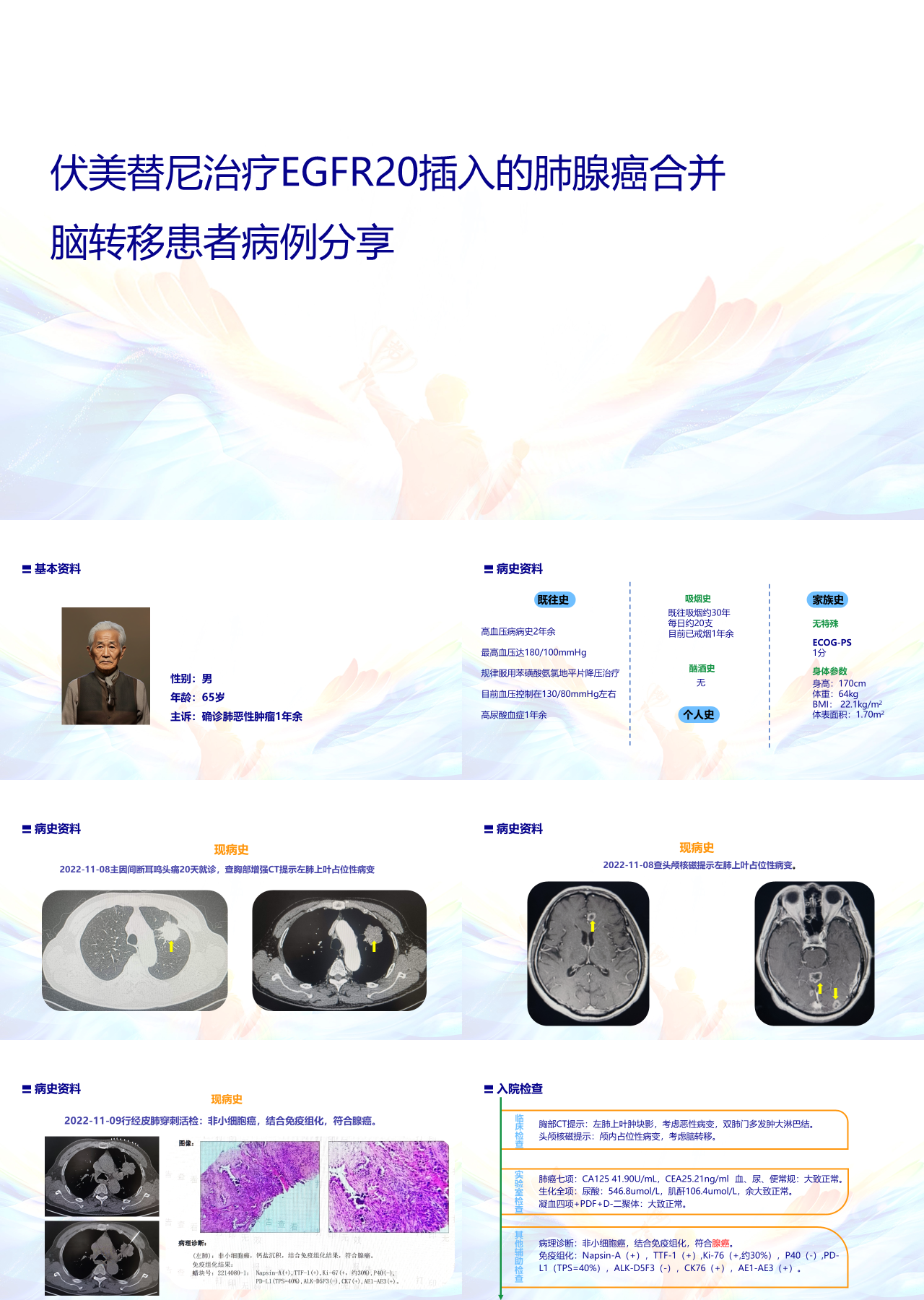 标准静态简约企业培训伏美替尼治疗EGFR20插入的肺腺癌合并脑转移患者病例分享