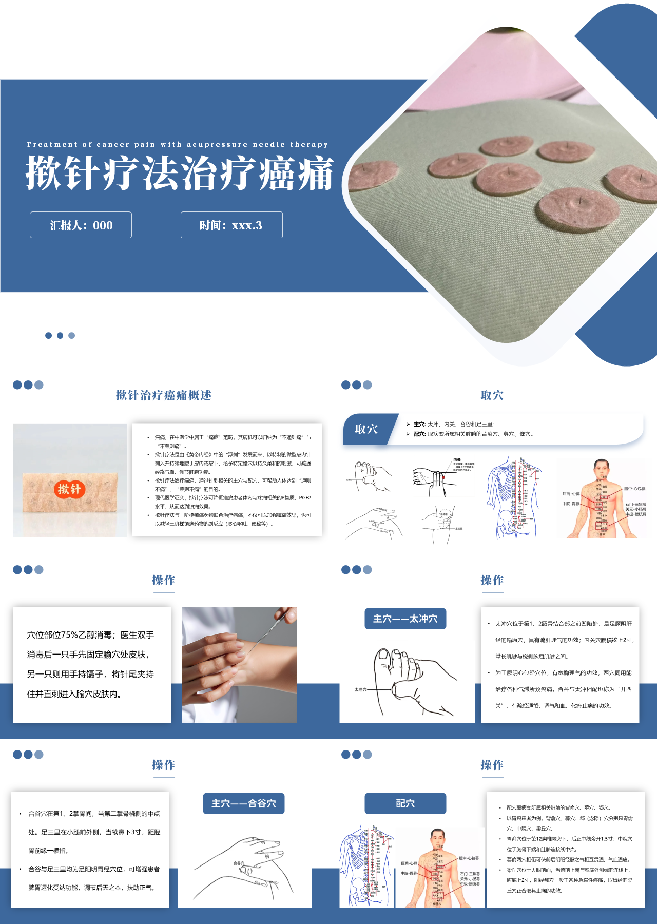 标准静态蓝色主题教育揿针疗法治疗癌痛